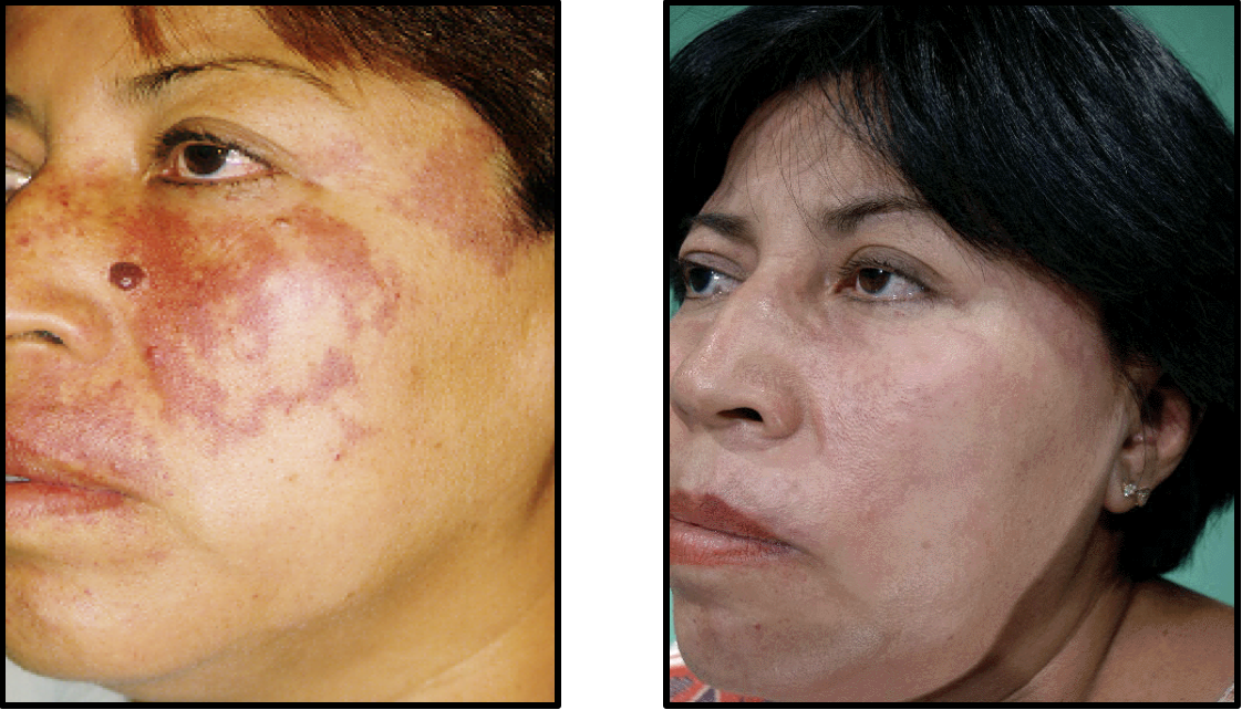 Vascular Lesions Treated with Laser